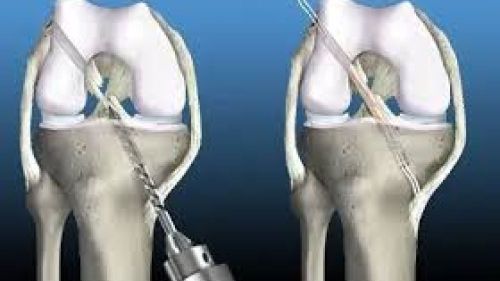 Artroskopik Ön Çapraz Bağ Ameliyatı